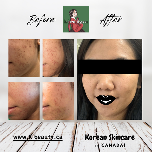 Before & After Korean Skincare L**